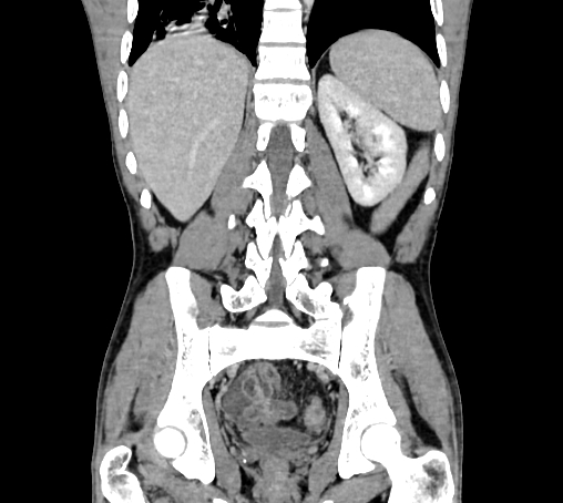 File:Bronchiectasis in Crohn disease (Radiopaedia 60311-67977 C 59).jpg
