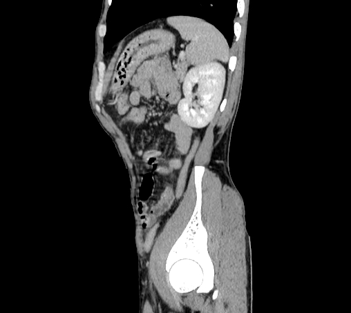 File:Bronchiectasis in Crohn disease (Radiopaedia 60311-67977 D 92).jpg