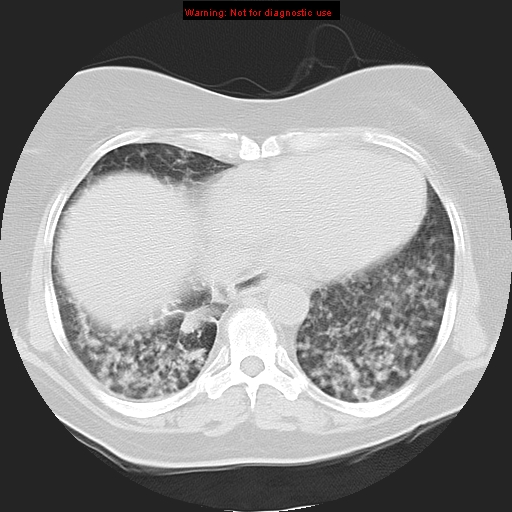 Bronchoalveolar carcinoma (Radiopaedia 13224-13233 Axial lung window 32).jpg