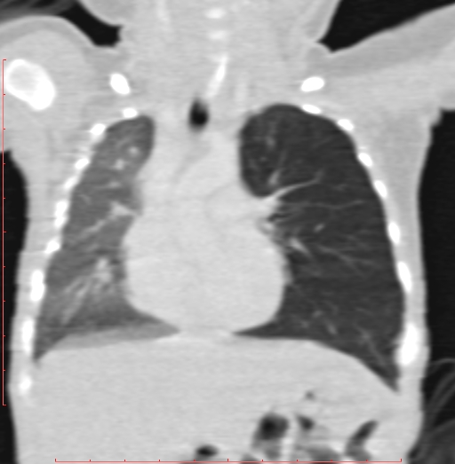 Bronchogenic cyst (Radiopaedia 78599-91409 Coronal lung window 107).jpg