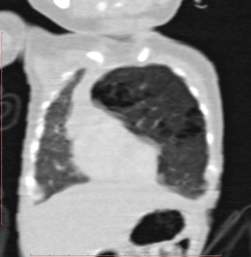 Bronchogenic cyst (Radiopaedia 78599-91409 Coronal lung window 60).jpg