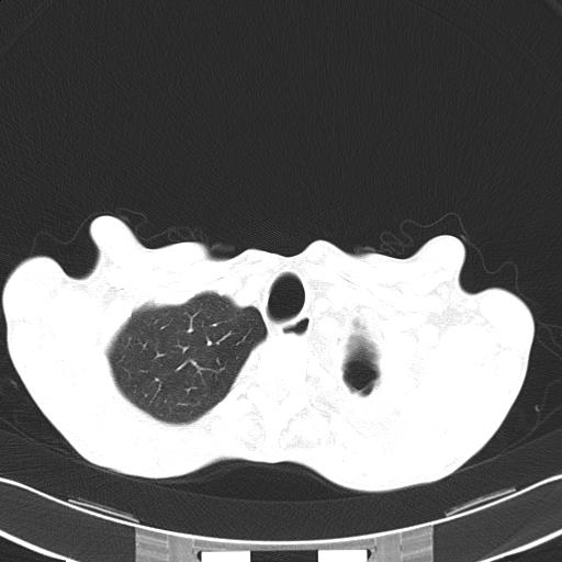 Bronchopleural fistula secondary to tuberculosis (Radiopaedia 20415-20322 Axial lung window 10).jpg