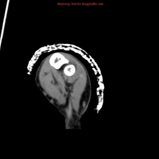 Brown tumor (Radiopaedia 12460-12694 Axial non-contrast 124).jpg