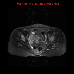 File:Brown tumors (Radiopaedia 9666-10290 Axial T2 fat sat 16).jpg