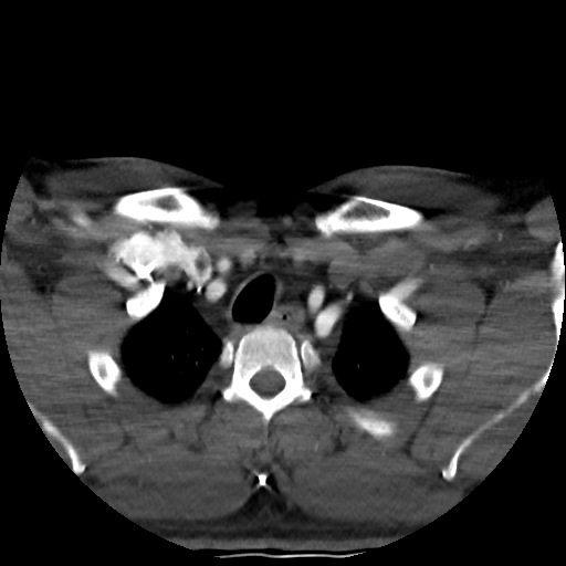 Buccal fat pad arteriovenous malformation (Radiopaedia 70936-81144 A 98).jpg