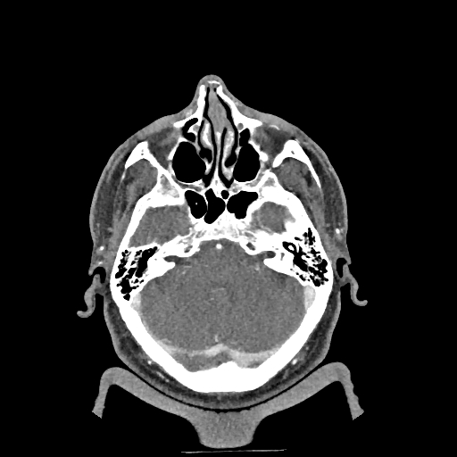 Buccal fat pad arteriovenous malformation (Radiopaedia 70936-81144 D 260).jpg