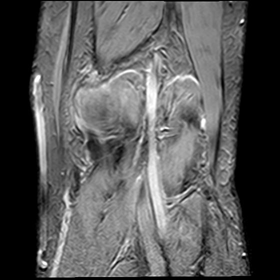 File:Bucket handle tear - medial meniscus (Radiopaedia 29250-29664 B 19).jpg