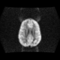 File:Burkitt lymphoma of the orbit- pre and post chemotherapy (Radiopaedia 31214-31929 Axial DWI 11).jpg