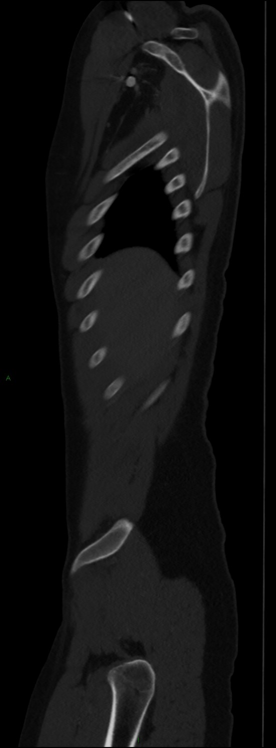 Burst fracture (Radiopaedia 83168-97542 Sagittal bone window 27).jpg
