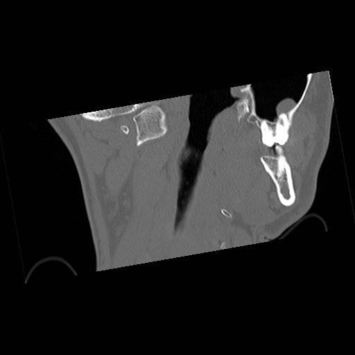 C1-C2 "subluxation" - normal cervical anatomy at maximum head rotation (Radiopaedia 42483-45607 Coronal non-contrast 7).jpg