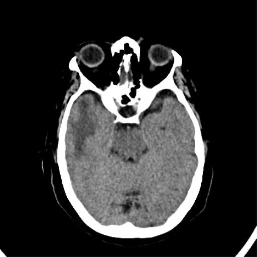 File:CNS Lymphoma (Radiopaedia 44198-47794 Axial non-contrast 14).png
