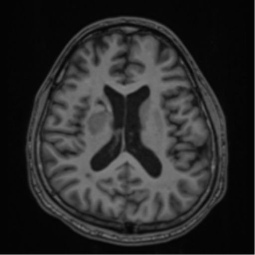 CNS vasculitis (Radiopaedia 55715-62263 Axial T1 43).png