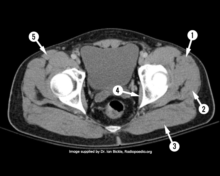 File:CT pelvis - axial (anatomy quiz) (Radiopaedia 60605).jpg