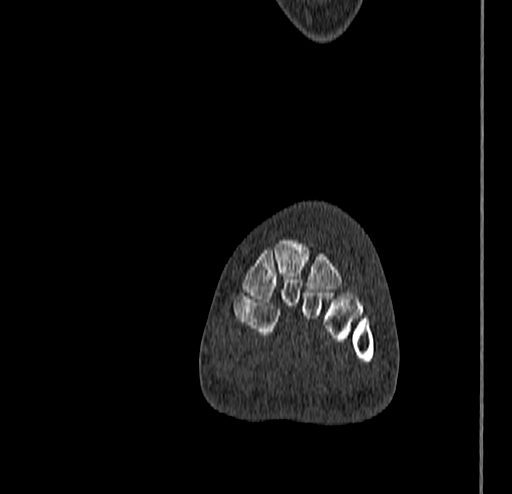 Calcaneal fracture - Sanders type 4 (Radiopaedia 90179-107370 Coronal bone window 42).jpg