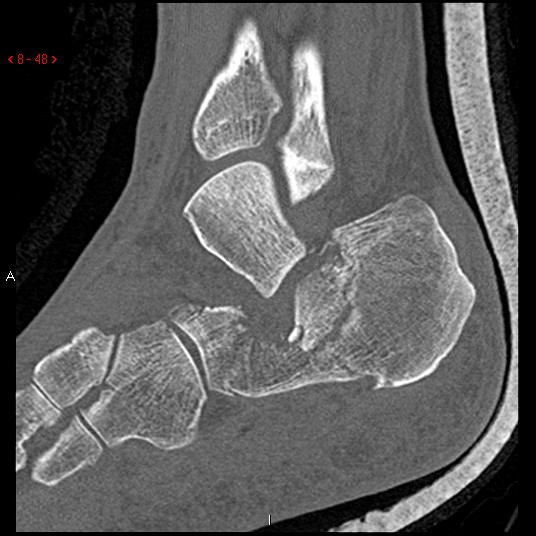 File:Calcaneal fracture and associated spinal injury (Radiopaedia 17896-17656 Sagittal bone window 5).jpg
