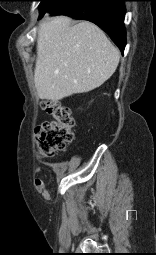 Calcified adrenal glands and Spigelian hernia (Radiopaedia 49741-54988 C 136).jpg