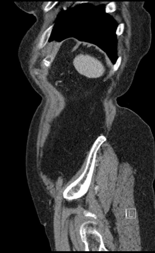 Calcified adrenal glands and Spigelian hernia (Radiopaedia 49741-54988 C 21).jpg