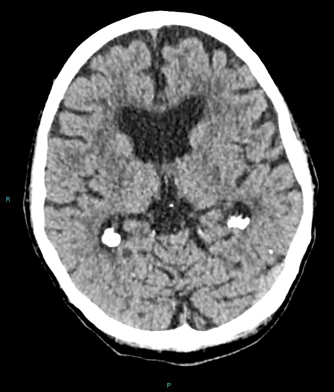 Calcified cerebral emboli from left ventricular thrombus (Radiopaedia 84420-99758 Axial non-contrast 50).jpg