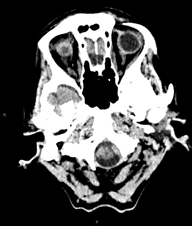 Calcified cerebral emboli from left ventricular thrombus (Radiopaedia 84420-99758 Axial non-contrast 81).jpg