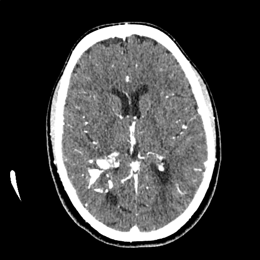 Calcified cerebral hydatid cyst (Radiopaedia 65603-74717 Axial with contrast 41).jpg
