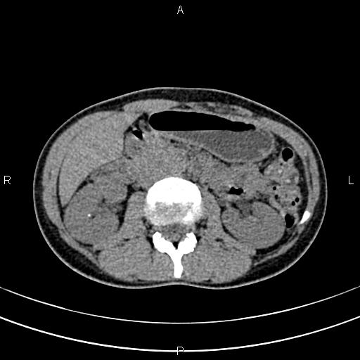 File:Calcified hepatic hydatid cyst (Radiopaedia 83870-99072 Axial non-contrast 77).jpg