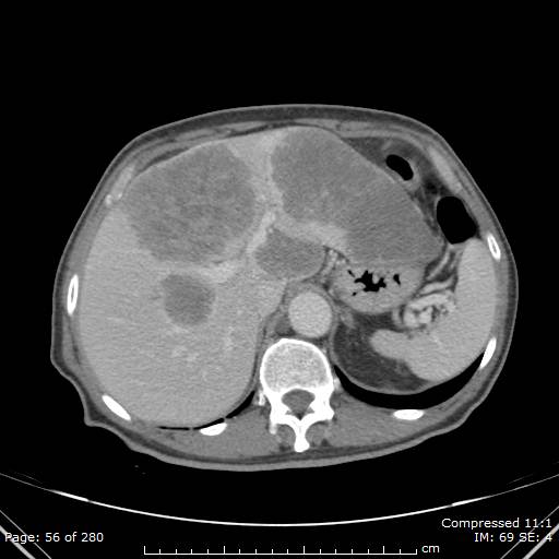 Calcified liver metastases (Radiopaedia 44699-48470 B 20).jpg