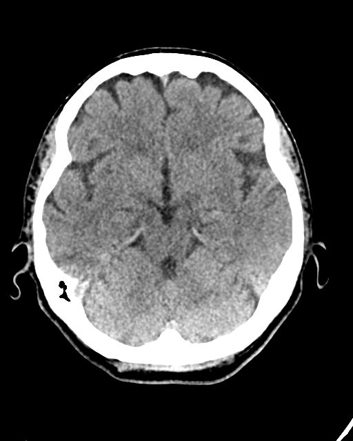 Calcified meningioma (Radiopaedia 74361-85243 Axial non-contrast 33).jpg