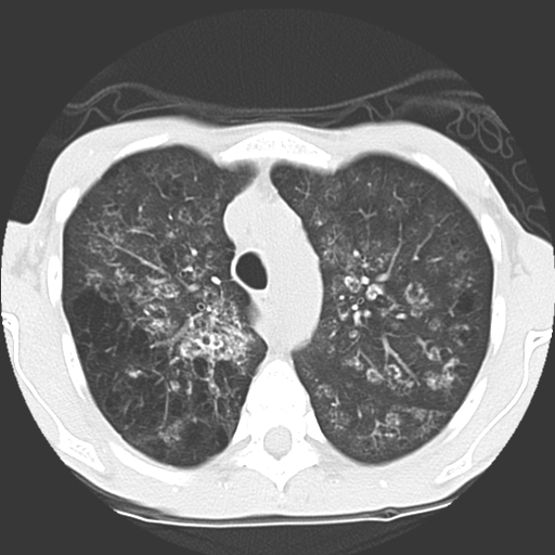 File:Calciphylaxis and metastatic pulmonary calcification (Radiopaedia 10887-11317 Axial lung window 10).jpg
