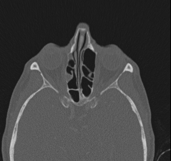 Caldwell-Luc operation (Radiopaedia 52329-58225 Axial bone window 23).jpg