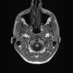 Callosal dysgenesis with interhemispheric cyst (Radiopaedia 53355-59335 Axial T1 5).jpg