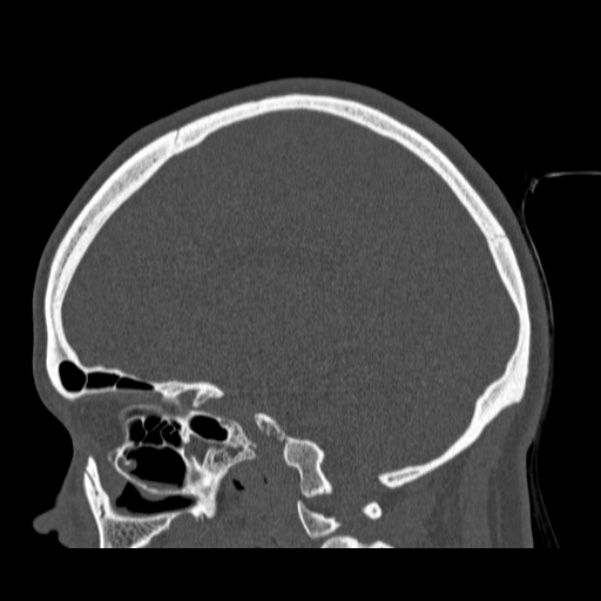 Calvarial osteoma (Radiopaedia 36520-38079 Sagittal bone window 47).jpg