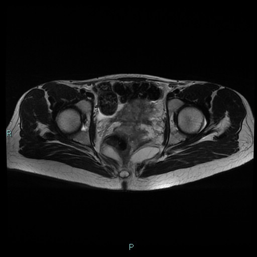 File:Canal of Nuck cyst (Radiopaedia 55074-61448 Axial T2 13).jpg