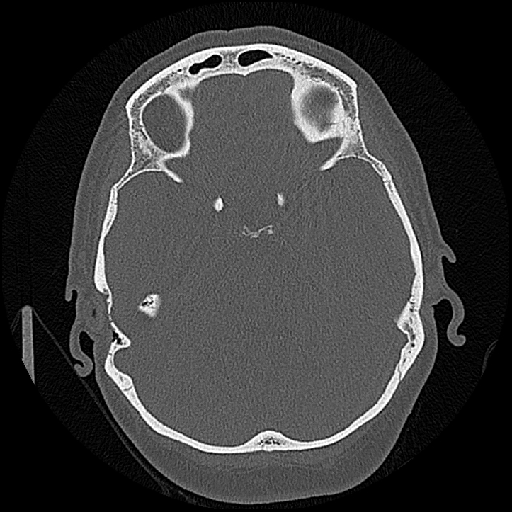 Canal up mastoidectomy (Radiopaedia 78108-90638 Axial bone window 112).jpg