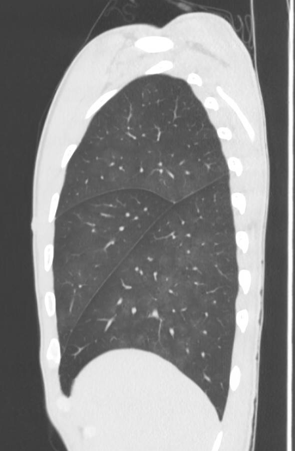 Cannabis-induced diffuse alveolar hemorrhage (Radiopaedia 89834-106946 Sagittal lung window 24).jpg