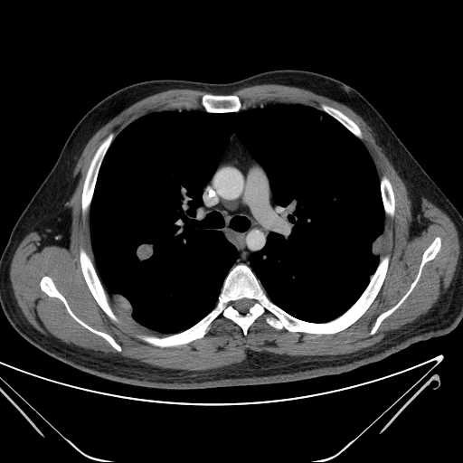 File:Cannonball pulmonary metastases (Radiopaedia 67684-77101 D 113).jpg