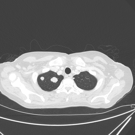 Canonball lung metastasis (Radiopaedia 77634-89837 Axial lung window 22).jpg