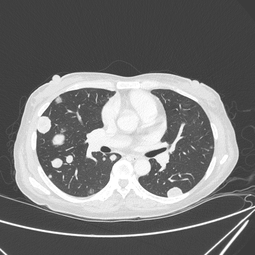 File:Canonball lung metastasis (Radiopaedia 77634-89837 Axial lung window 87).jpg