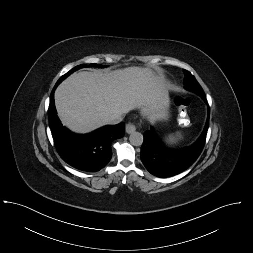 Carcinoid tumor - terminal ileum (Radiopaedia 60931-68740 Axial non-contrast 4).jpg