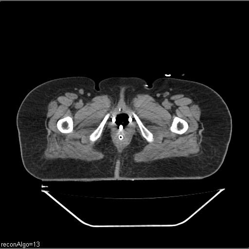 Carcinoma cervix- brachytherapy applicator (Radiopaedia 33135-34173 Axial non-contrast 51).jpg