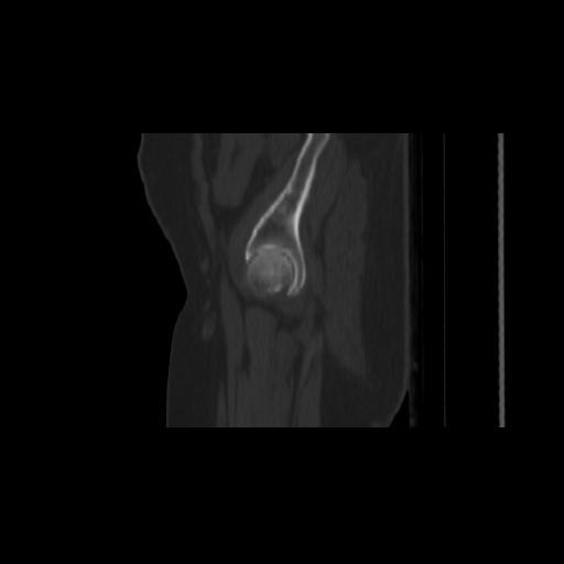 File:Carcinoma cervix- brachytherapy applicator (Radiopaedia 33135-34173 Sagittal bone window 8).jpg
