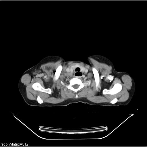 File:Carcinoma of esophagus (Radiopaedia 27356-27550 A 31).jpg