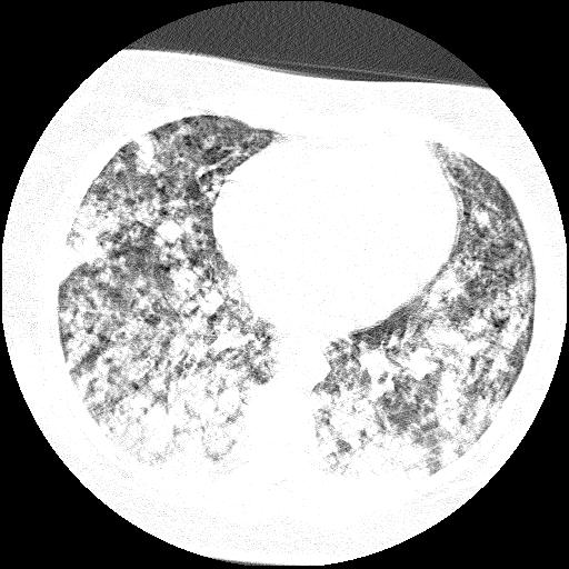 Cardiac angiosarcoma (Radiopaedia 66010-75181 Axial lung window 36).jpg