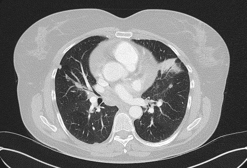 Cardiac sarcoidosis (Radiopaedia 74548-85534 Axial lung window 43).jpg