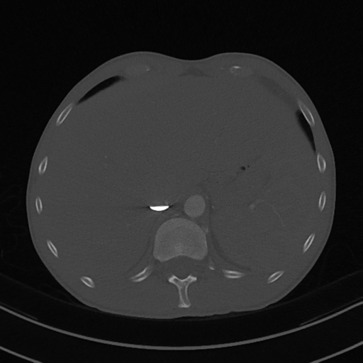 File:Cardiac tumor - undifferentiated pleomorphic sarcoma (Radiopaedia 45844-50134 Axial bone window 65).png