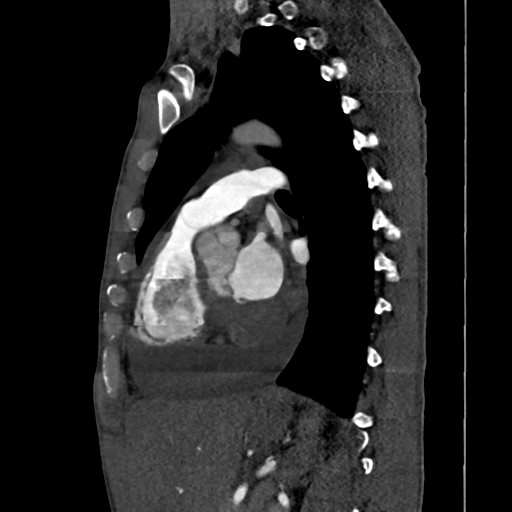 Cardiac tumor - undifferentiated pleomorphic sarcoma (Radiopaedia 45844-50134 B 31).png