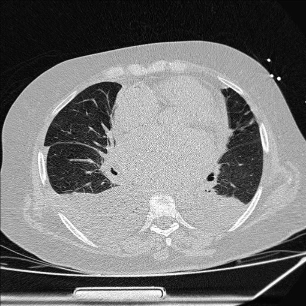 Cardiogenic pulmonary edema (Radiopaedia 29213-29609 Axial lung window 56).jpg