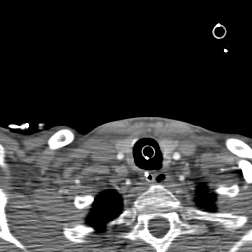 Carotid arterial dissection (Radiopaedia 30001-30548 B 31).jpg