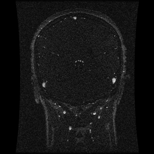 Carotid arterial dissection with acute cerebral infarction (Radiopaedia 26636-26784 MRV 73).jpg