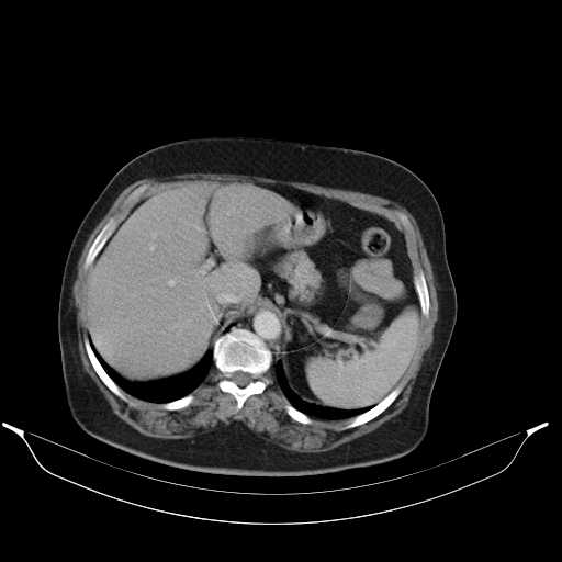 File:Carotid body tumor (Radiopaedia 21021-20948 A 54).jpg