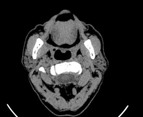 Carotid body tumor (Radiopaedia 61750-69757 Axial non-contrast 20).jpg